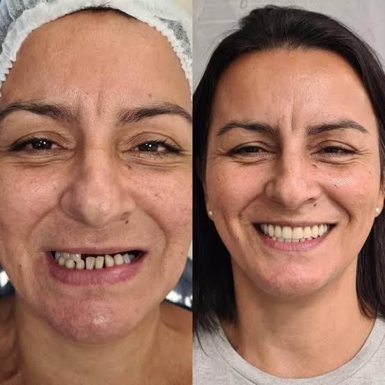 Antes e depois de prótese protocolo: Fim da insegurança ao falar e sorrir.