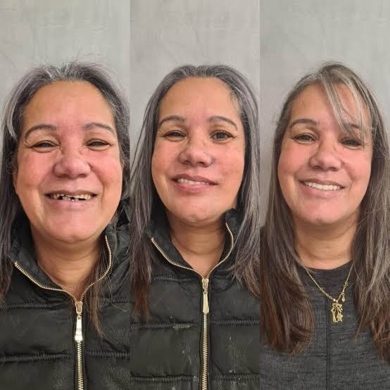 Antes e depois de prótese protocolo: Resultado em poucas semanas.