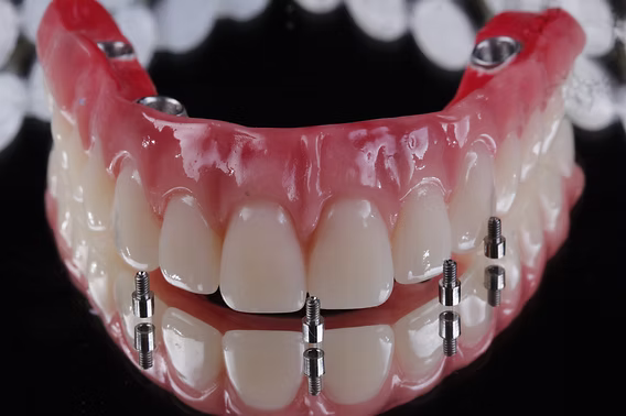 Prótese protocolo fixa sobre implantes, com dentes de aparência natural