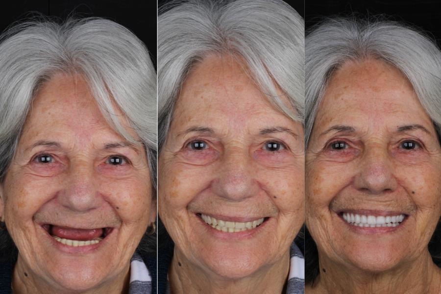 Antes e depois de prótese protocolo: Estética natural e harmonia do rosto.