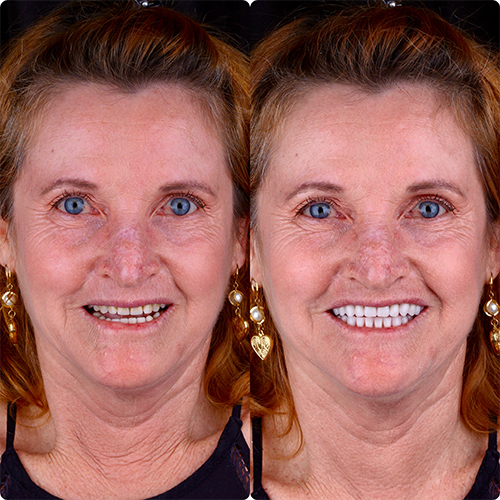 Antes e depois de prótese protocolo: Dentes fixos, sem cola e sem incômodo.