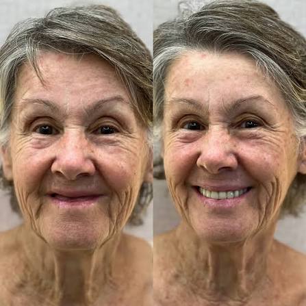 Antes e depois de prótese protocolo: Sorriso alinhado e bem encaixado.
