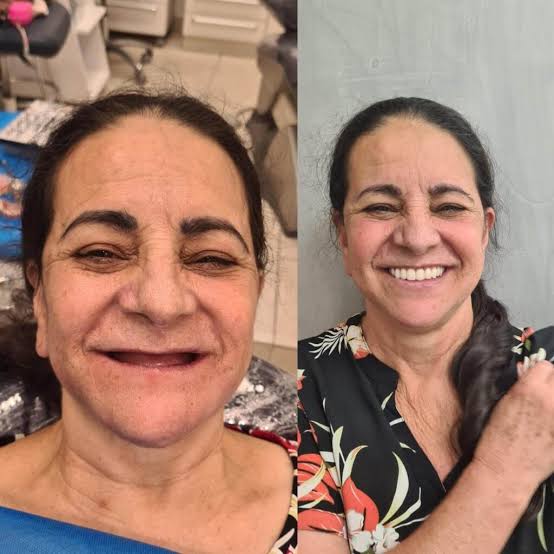 Antes e depois de prótese protocolo: Confiança para sorrir nas fotos.