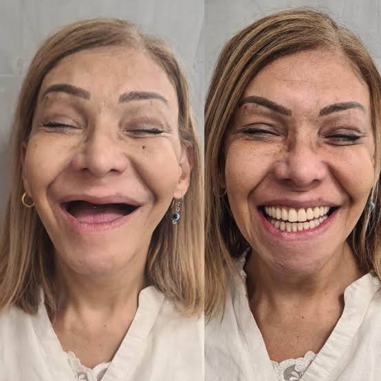 Antes e depois de prótese protocolo: Mordida firme para comer de tudo.