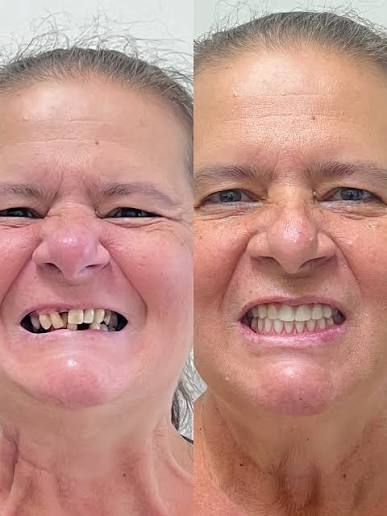 Antes e depois de prótese protocolo: Volume do rosto de volta ao normal.